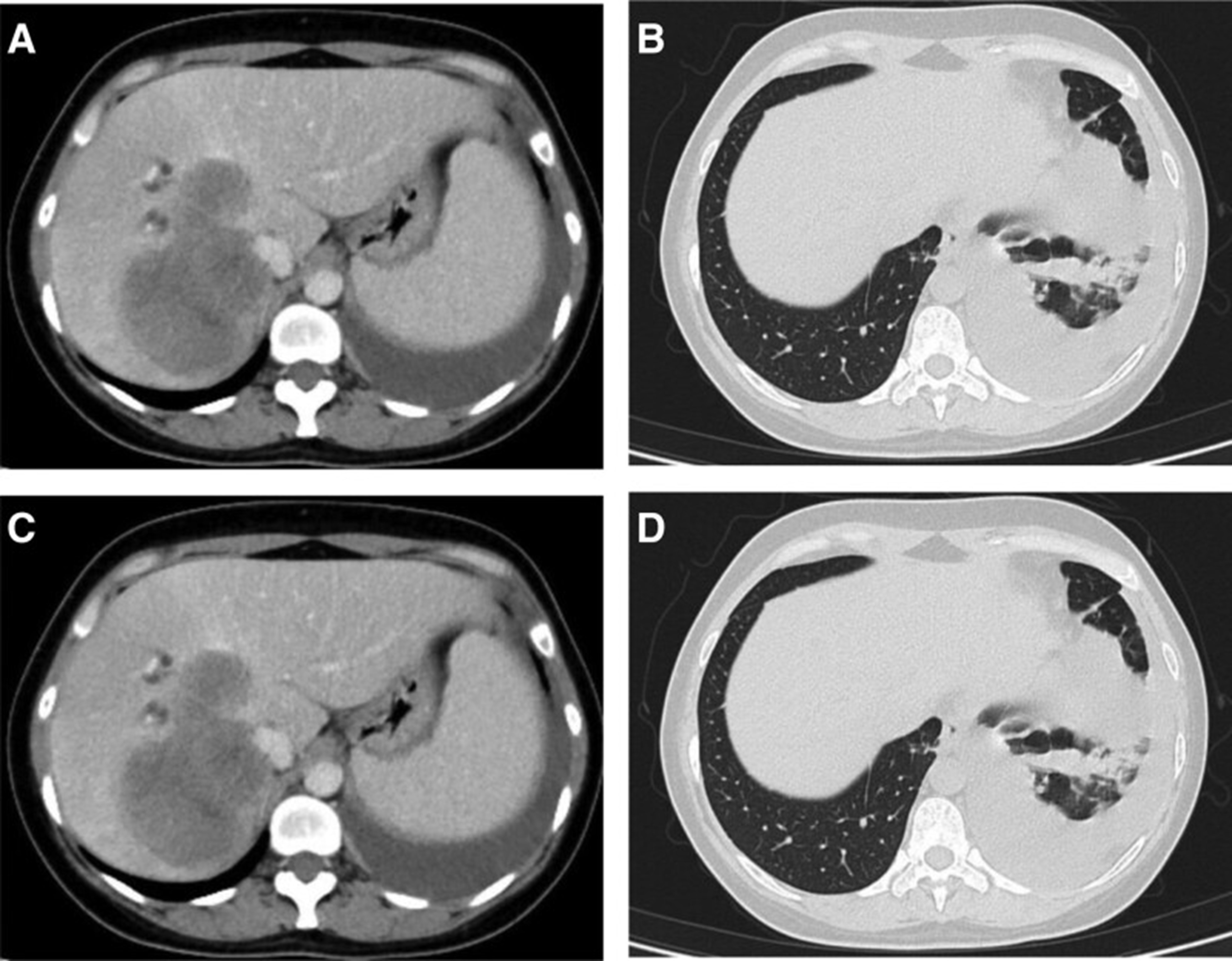 【佳学基因检测】基因检测具有ALK 融合突变而且是高 PD-L1 表达的晚期肺腺癌患者 ALK-TKI 靶向药物治疗